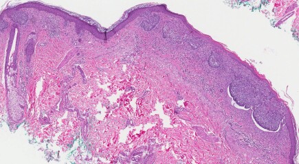 Artikel - Hautkrebs – Symptome, Behandlung und Prävention